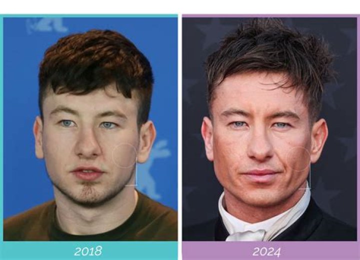 Barry Keoghan&rsquo;s Plastic Surgery plastic surgery for jaw reconstruction