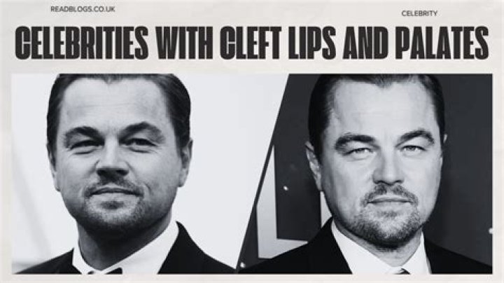 Celebrities With Cleft Lips Telegraph