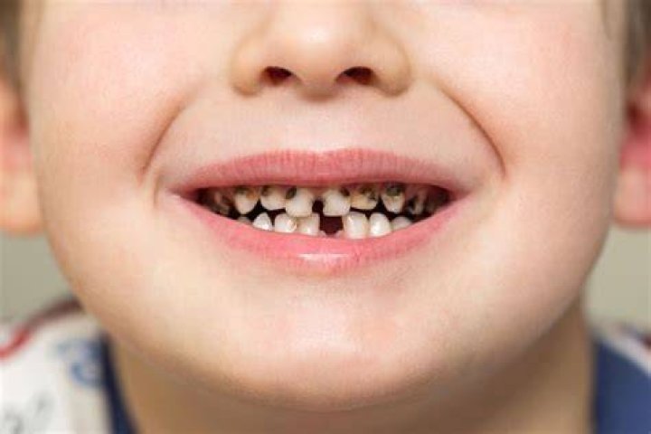 Como consertar dentes podres e 5 melhores maneiras de evitar a podrid&atilde;o