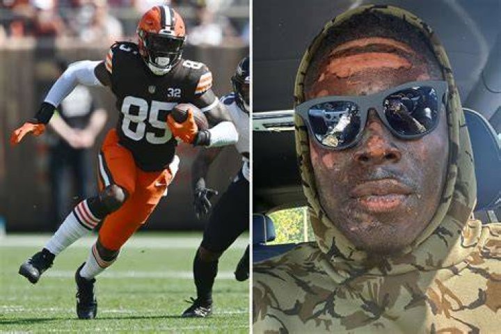 David Njoku seen with horror burns on his face after NFL star injured