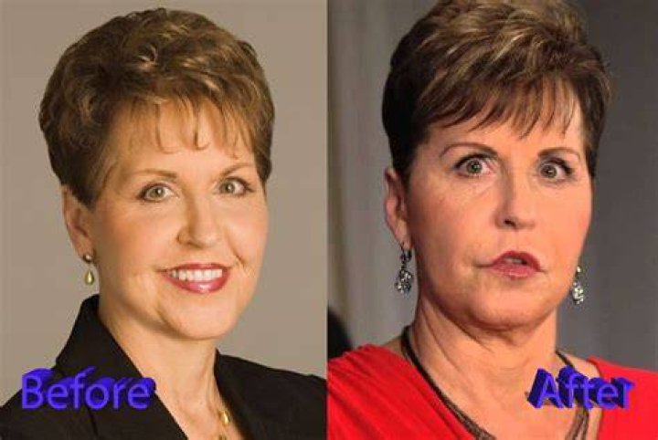 Joyce Meyer Lip Augmentation Plastic Surgery Before and After Celebie