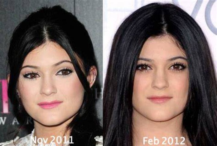 Kylie Jenner Plastic Surgery Before and After WHO Magazine