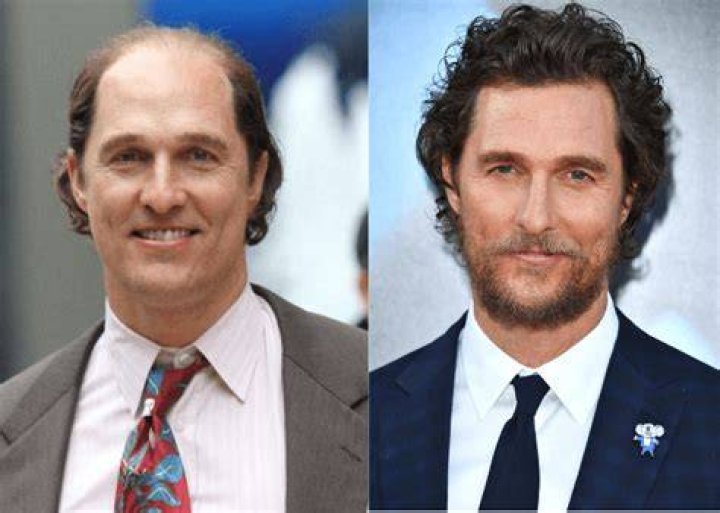 Male Celebrities Who Wear Toupees and Wigs Due to Hair Loss (2022)