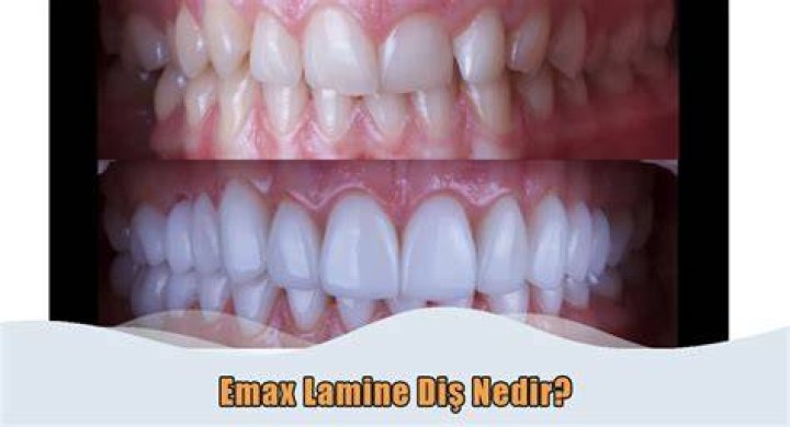 Porselen Lamine Nedir? Ankara Dr. Dt. &Ouml;mer Bayar