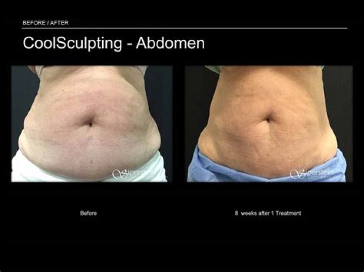 Should I Avoid CoolSculpting After Linda Evangelista's Reaction? Glowday