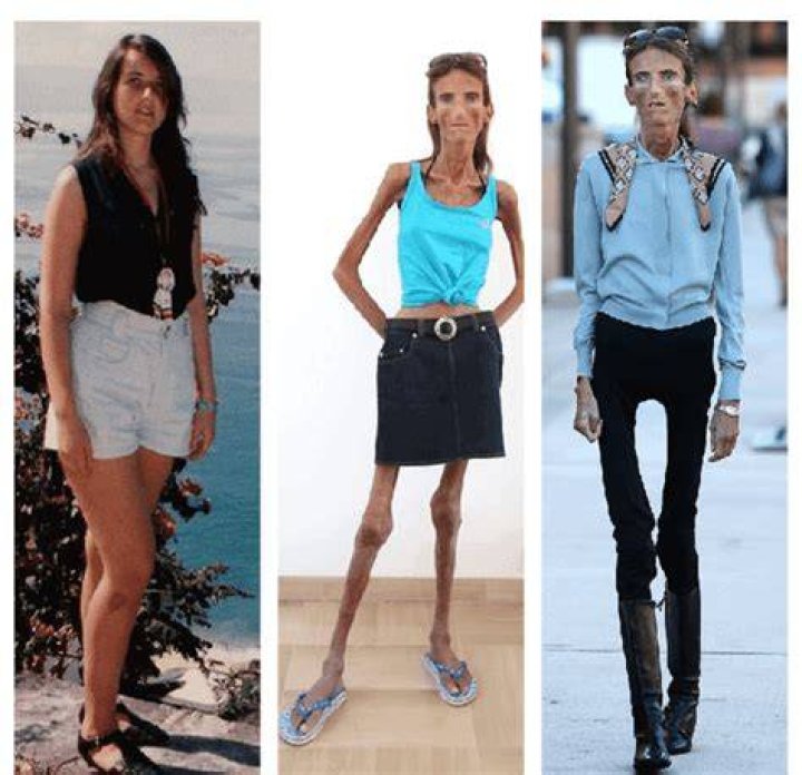 The Remarkable Transformation: Meet The Skinniest Person In The World